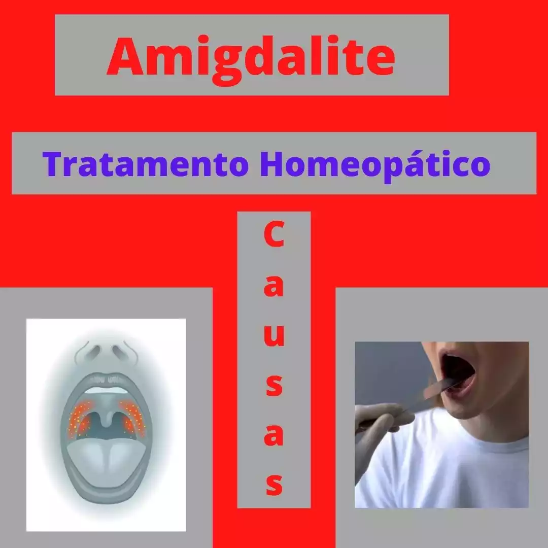 Amidalite ou amigdalite  Biblioteca Virtual em Saúde MS